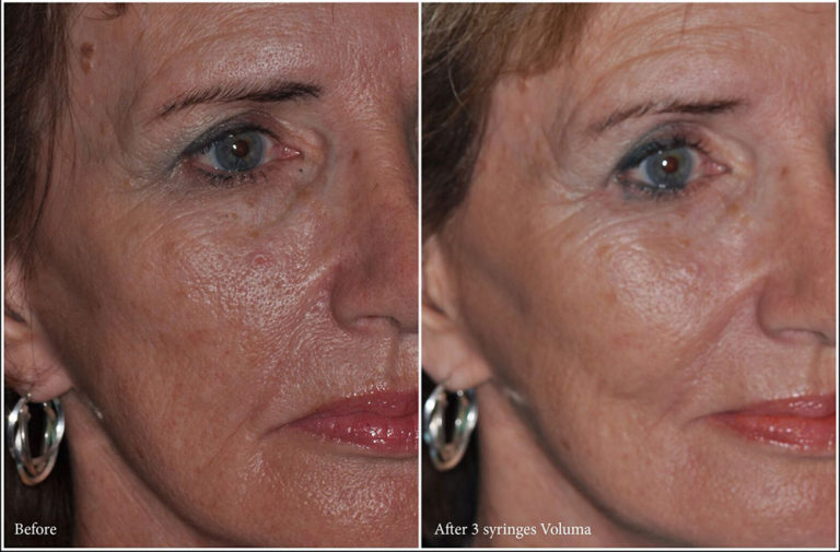 Houston Dermal Fillers Treat Wrinkles And Boost Volume David De Jongh